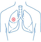 Lung cancer