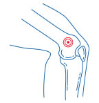 Sarcoma